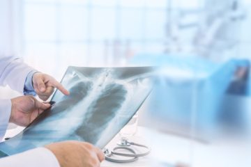 تشخیص گرانولوماتوز با پلی‌آنژیت از روی عکس قفسه سینه