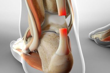 پارگی تاندون آشیل