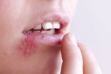 ویروس تبخال می‌تواند باعث افزایش ریسک ابتلا به زوال عقل شود