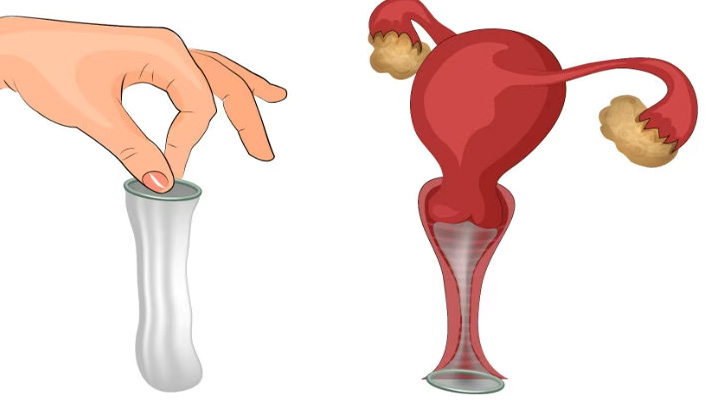 کاندوم زنانه؛ انواع، مزایا، معایب و روش استفاده_سلوادور 7 نحوه استفاده از کاندوم زنانه