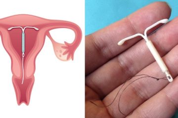 آی یو دی از روشهای پیشگیری از بارداری که می تواند موجب متروراژی شود