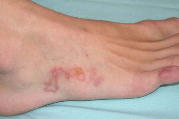 عفونت انگلی - عفونت انگلی - علائم عفونت انگلی