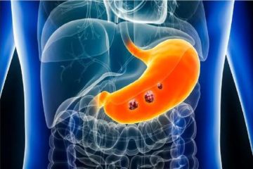 پیشرفت چشمگیر در تشخیص زودهنگام سرطان معده با استفاده از هوش مصنوعی