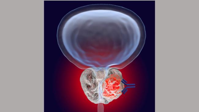پروژه تحول برای تشخیص زودهنگام سرطان پروستات در بریتانیا آغاز شد