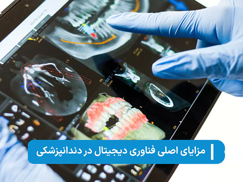 مزایای ایمپلنت دیجیتال