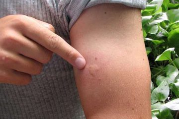 جای نیش پشه