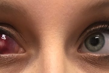 چربی داخل چشم پینگوکولا