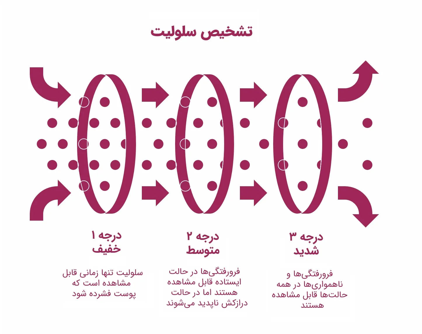 تفاوت لیپیدما و سلولیت: راهنمای تشخیص و درمان_سلوادور 11 اینفوگرافیک درجهبندی شدت سلولیت
